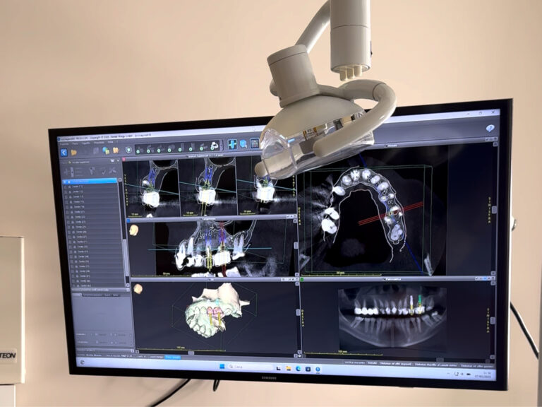 Impianto dentale come funziona