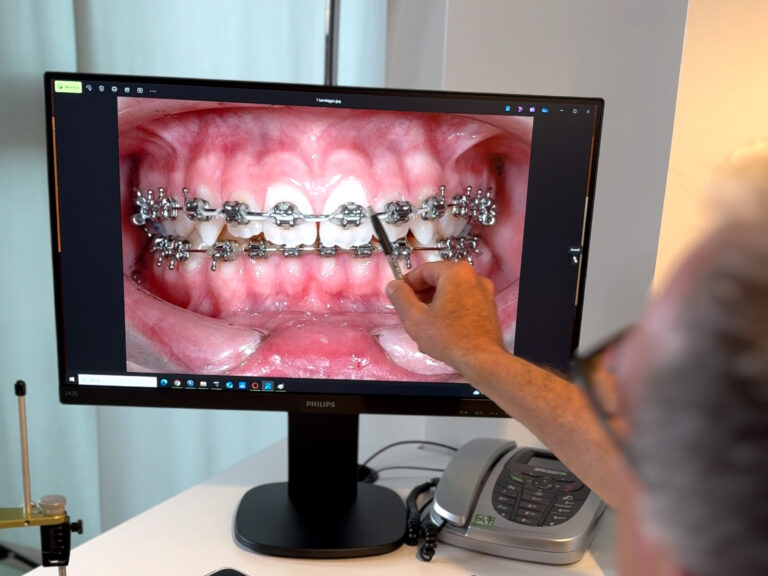 Come funziona Apparecchio fisso