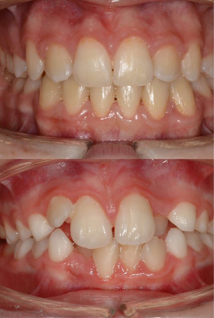 Moro Amorfini Prima e dopo - Dentista a Gallarate