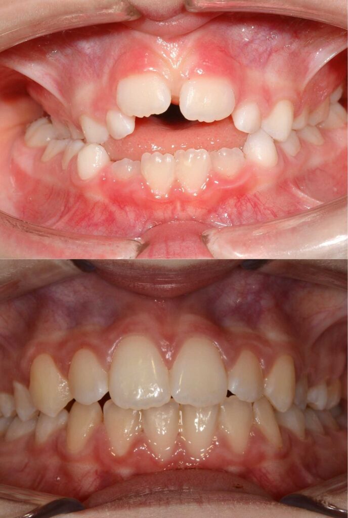 Moro Amorfini Prima e dopo - Dentista a Gallarate