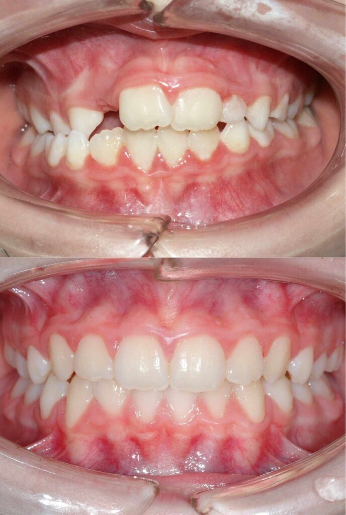 Moro Amorfini Prima e dopo - Dentista a Gallarate