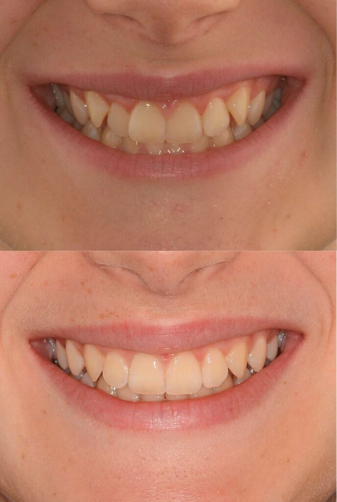 Moro Amorfini Prima e dopo - Dentista a Gallarate