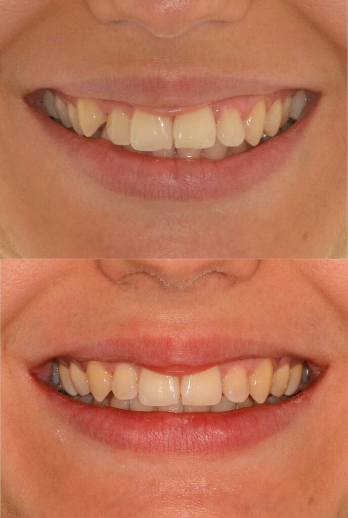 Moro Amorfini Prima e dopo - Dentista a Gallarate