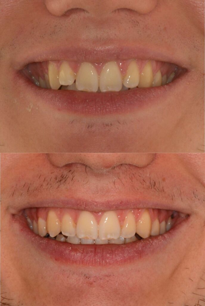 Moro Amorfini Prima e dopo - Dentista a Gallarate
