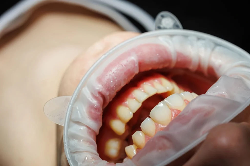 Pazienti diabetici e parodontosi - Perché i pazienti diabetici hanno più rischio di parodontosi