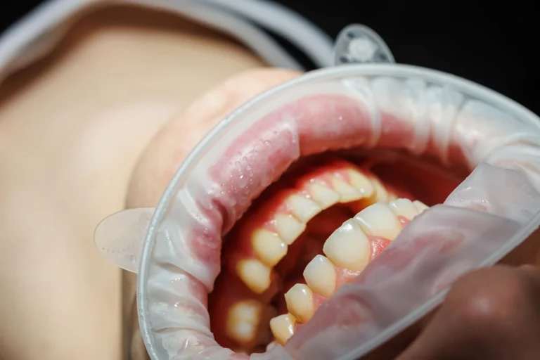 Pazienti diabetici e parodontosi - Perché i pazienti diabetici hanno più rischio di parodontosi