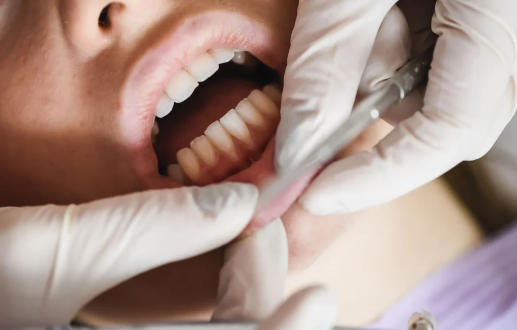 Pazienti diabetici e parodontosi - Perché i pazienti diabetici hanno più rischio di parodontosi
