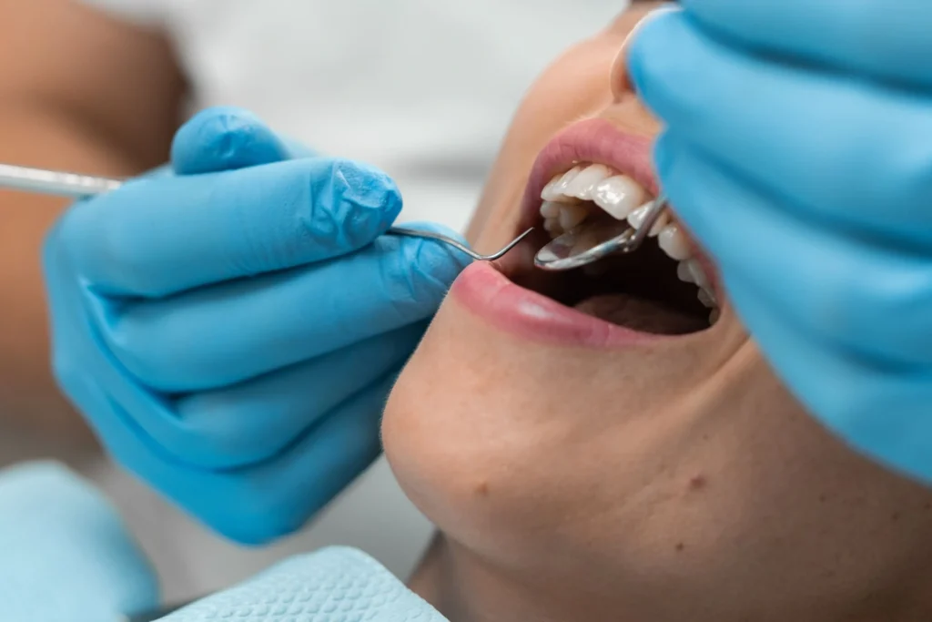 Ogni quanto fare la pulizia dentale